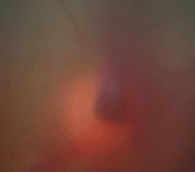 甜蜜的阿伯–談糖尿病眼病變