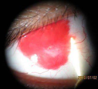 眸上一點紅，原是結膜血！