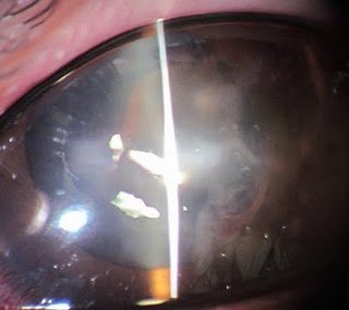 少女長戴隱形眼鏡 角膜潰瀾幾失明_圖2