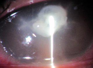 少女長戴隱形眼鏡 角膜潰瀾幾失明