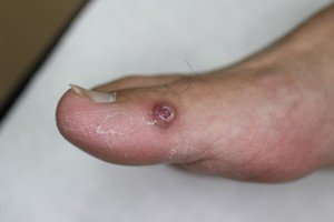 青春痘流血不止 原來是化膿性肉芽腫在作怪