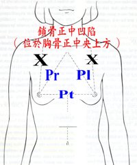 整形醫師教妳如何消除八字奶？談乳房外擴的治療方式！_圖1