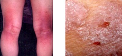 好討厭的癢癢小蟲∼談異位性皮膚炎的「診斷」條件！_圖1