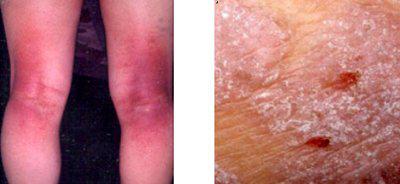 好討厭的癢癢小蟲∼談異位性皮膚炎的「診斷」條件！