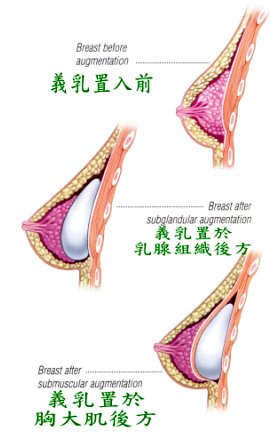 餵母乳會不會吸到義乳袋中的「鹽水」或「矽膠」成分？_圖1