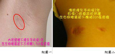 腋下「無疤」以示真奶？無事實依據的爆料成了家常菜？