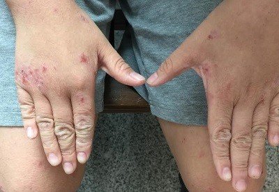 12年異位性皮膚炎惡化,飼養寵物須留意