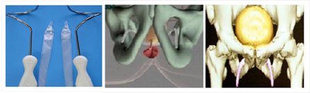 婆婆媽媽的苦惱：婦女尿失禁_圖1