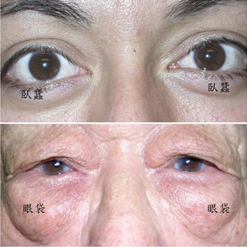 淺談眼整形美容手術_圖1