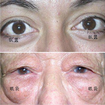 淺談眼整形美容手術