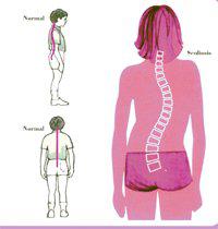 脊椎側彎該怎麼治療呢？