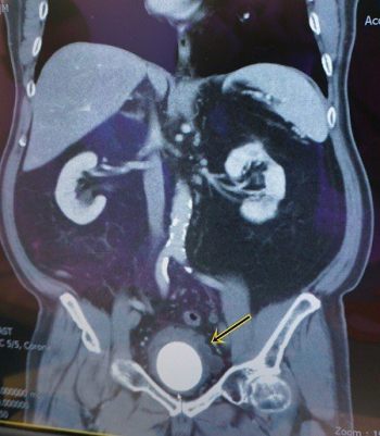 喝水不夠多 膀胱長出如奇異果的結石