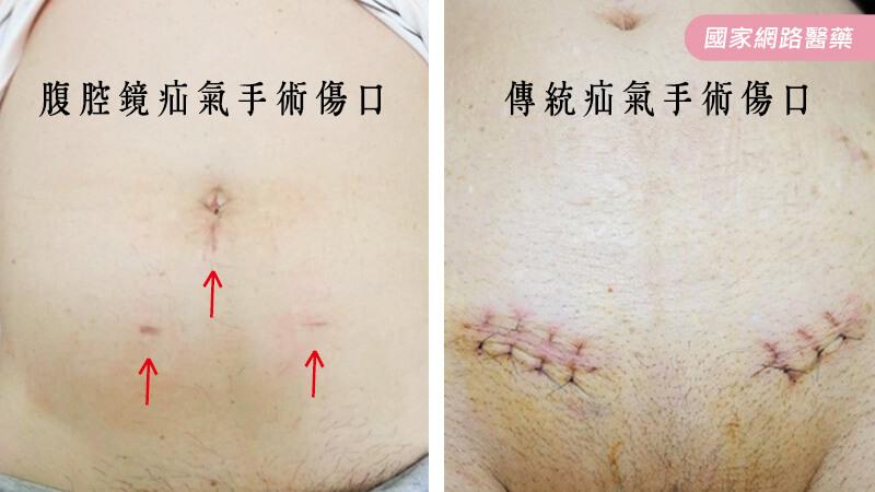 疝氣修補新醫材，降低術後疼痛及復發率_圖2