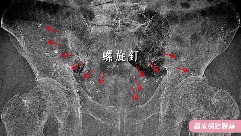 疝氣修補新醫材，降低術後疼痛及復發率_圖6
