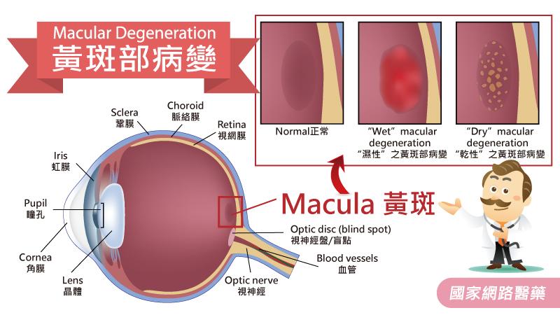 淺談老年性黃斑部病變_圖2