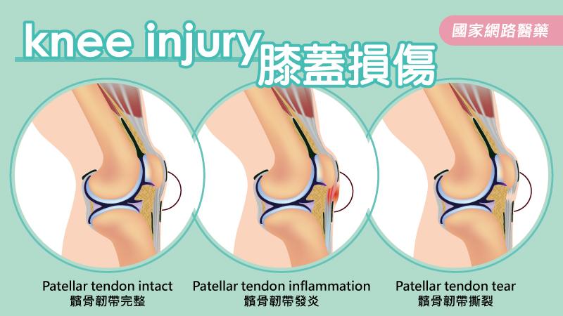 籃球選手的惡夢～膝蓋髕骨韌帶損傷_圖3
