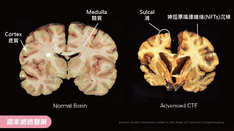 美式足球選手的『震盪效應』_圖2