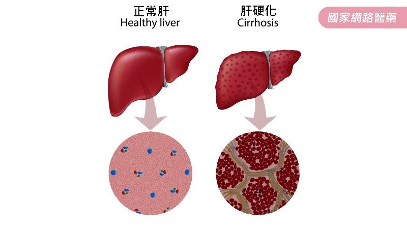 C型肝炎知多少？_圖3