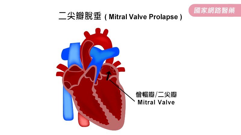 關於「二尖瓣脫垂」您知多少？_圖2