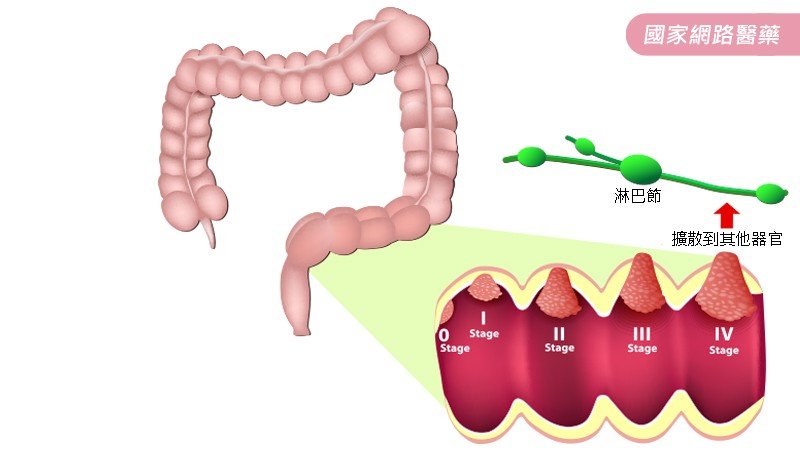 腹瀉又便秘，是否大腸癌宿？_圖2