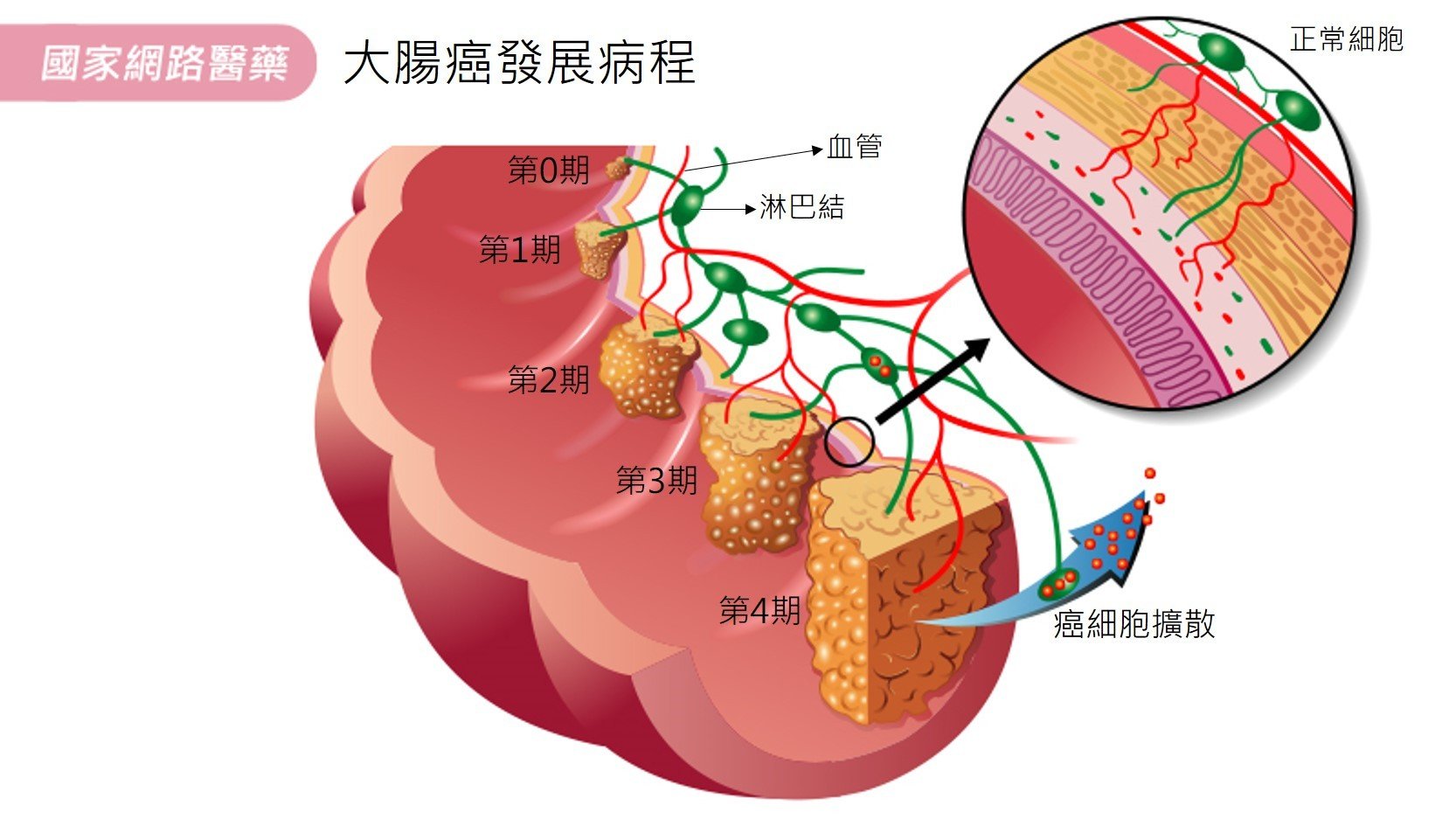 腹瀉又便秘，是否大腸癌宿？_圖3