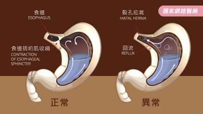 長期胃食道逆流，恐致食道腺癌