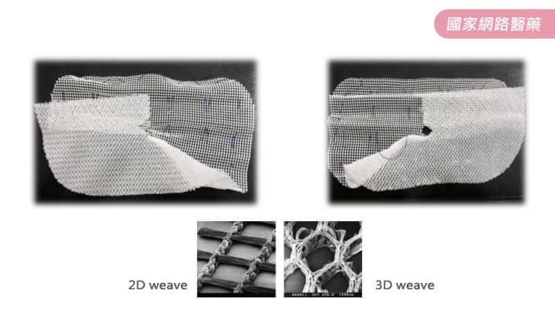 腹腔鏡疝氣手術進入新型態人工網膜時代_圖3