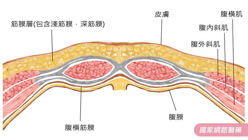 腹腔鏡疝氣手術進入新型態人工網膜時代_圖2 腹腔鏡疝氣手術進入新型態人工網膜時代_圖2