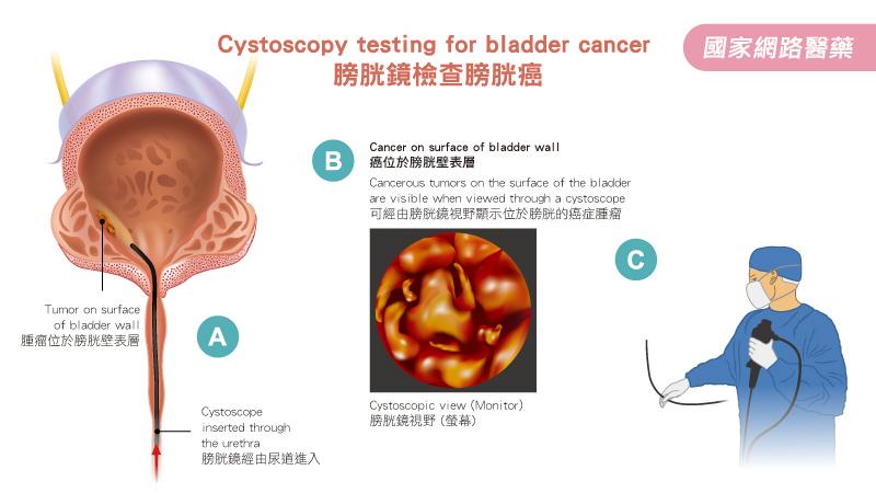 認識血尿的發生及檢查_圖3