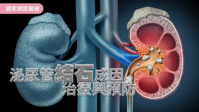 泌尿管結石成因、治療與預防
