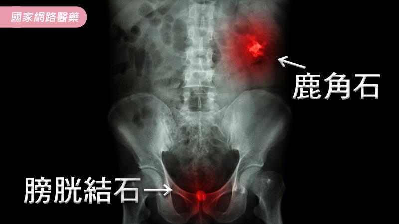 泌尿管結石成因、治療與預防_圖2