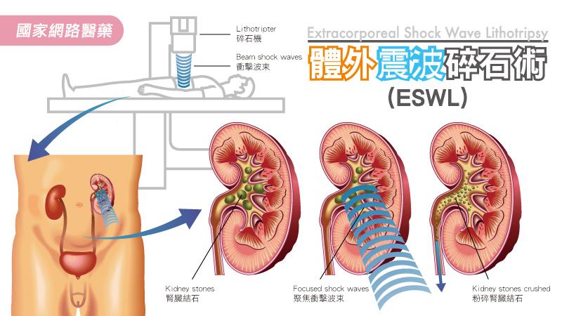 泌尿管結石成因、治療與預防_圖3