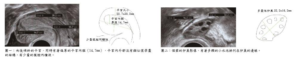 漫談多囊性卵巢症候群_圖2