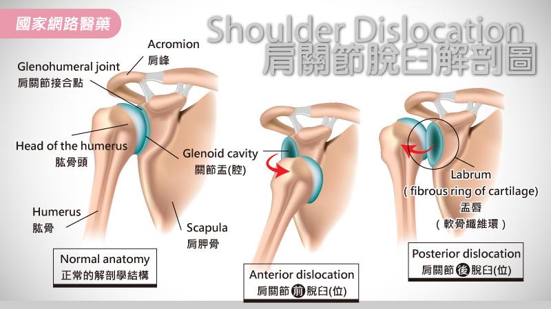 肩膀脫臼不可怕，就怕你輕忽_圖2