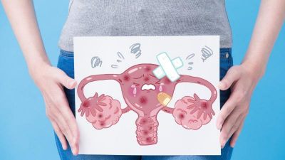 多囊性卵巢症候群會不孕？惱人多囊性卵巢症候群PCOS如何改善