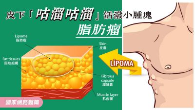 皮下「咕溜咕溜」活潑小腫塊－脂肪瘤