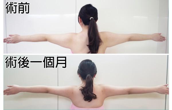 婚前曲線雕塑攻略｜顯微抽脂不需穿塑身衣 也輔助新娘完美塑身_圖4