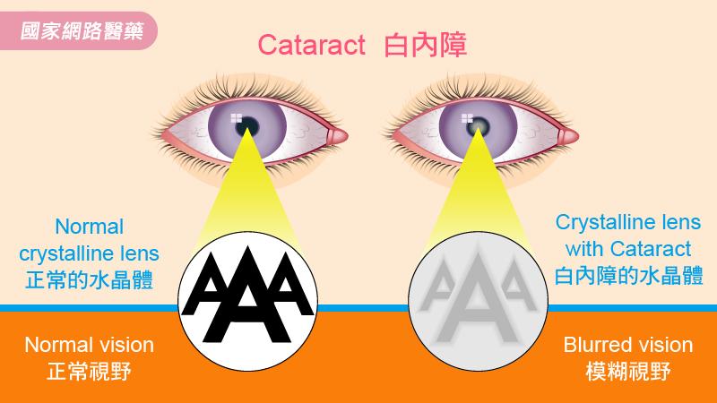 重度3C族，如何預防早發性白內障找上門_圖3