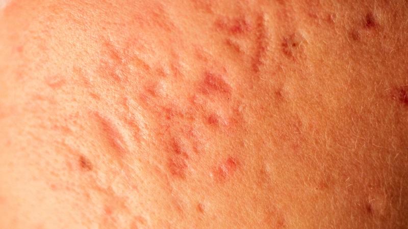 痘疤該如何治療？不同痘疤治療方式不同，對症下藥才是治療痘疤根本原則。_圖2