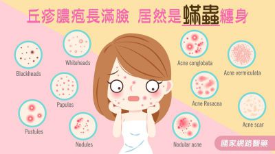 丘疹膿疱長滿臉 居然是蟎蟲纏身