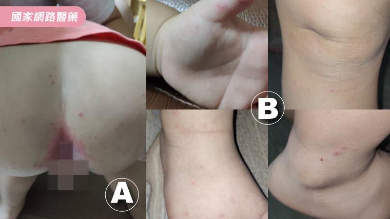 破解腸病毒9迷思_圖2