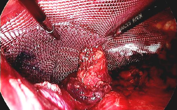 腹腔鏡疝氣修補手術搭配新型態人工網膜 創造醫師病患雙贏局面！_圖2