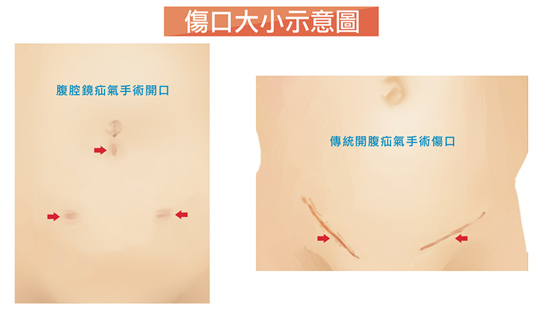 腹腔鏡疝氣修補手術搭配新型態人工網膜 創造醫師病患雙贏局面！_圖3
