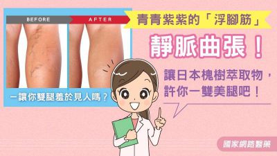 青青紫紫的「浮腳筋」－靜脈曲張！讓你雙腿羞於見人嗎？