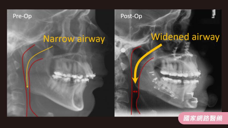 睡眠障礙與正顎手術_圖2