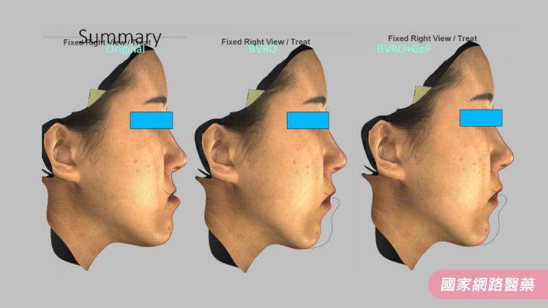 睡眠障礙與正顎手術_圖3