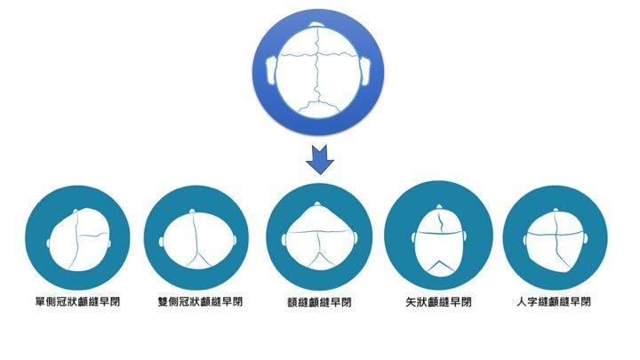 罕見疾病-多條顱縫早閉症 醫籲：及早擴張腦容量 把握大腦黃金成長期_圖2