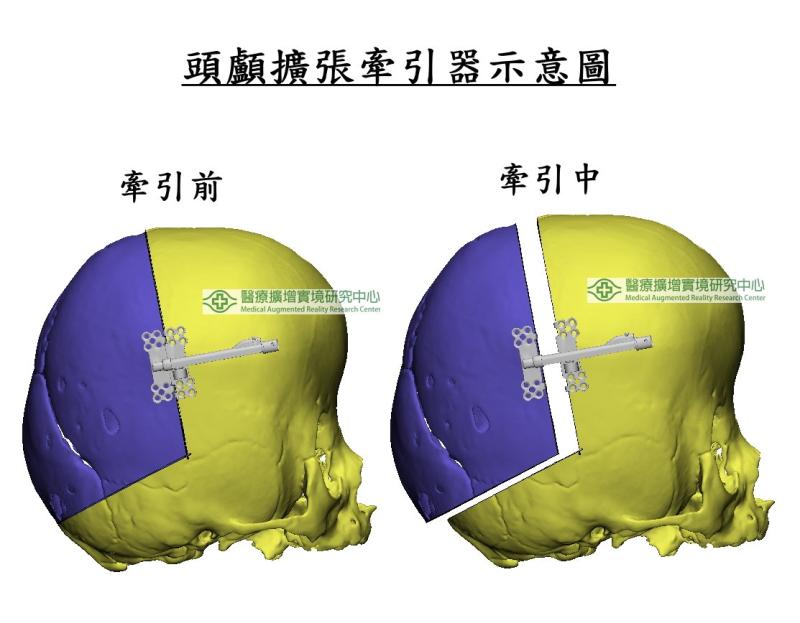 罕見疾病-多條顱縫早閉症 醫籲：及早擴張腦容量 把握大腦黃金成長期_圖3