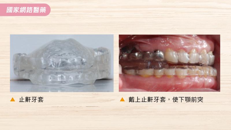 止鼾牙套的療效與迷思_圖2