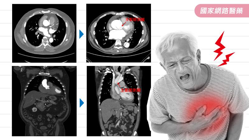 這些症狀要當心，恐是致命主動脈剝離！_圖2